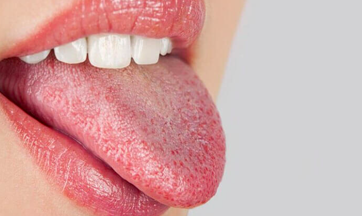 5 Biện Pháp Tự Nhiên Hiệu Quả Để Giảm Khô Miệng 5 Biện Pháp Tự Nhiên Hiệu Quả Để Giảm Khô Miệng