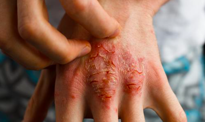 5 Mẹo Giúp Cải Thiện Giấc Ngủ Cho Người Bị Viêm Khớp Vảy Nến 5 Mẹo Giúp Cải Thiện Giấc Ngủ Cho Người Bị Viêm Khớp Vảy Nến