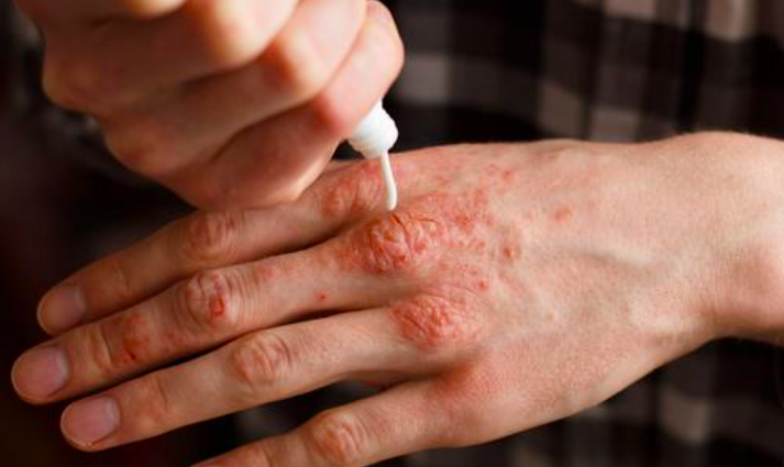 5 Mẹo Giúp Cải Thiện Giấc Ngủ Cho Người Bị Viêm Khớp Vảy Nến 5 Mẹo Giúp Cải Thiện Giấc Ngủ Cho Người Bị Viêm Khớp Vảy Nến