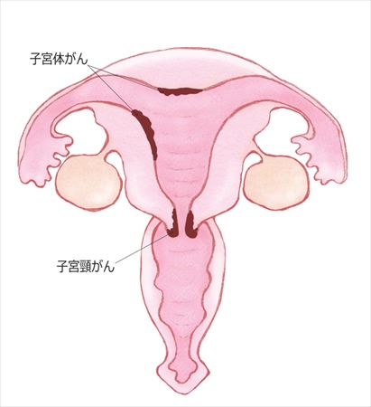 Giới Thiệu Về Các Loại Ung Thư Thường Gặp Ở Phụ Nữ Trên 50 Tuổi Giới Thiệu Về Các Loại Ung Thư Thường Gặp Ở Phụ Nữ Trên 50 Tuổi
