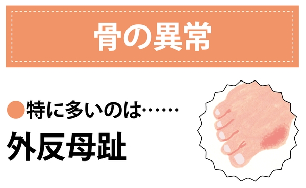 Nguyên Nhân Gây Ra Các Vấn Đề Về Chân Ở Phụ Nữ Là Gì? Nguyên Nhân Gây Ra Các Vấn Đề Về Chân Ở Phụ Nữ Là Gì?