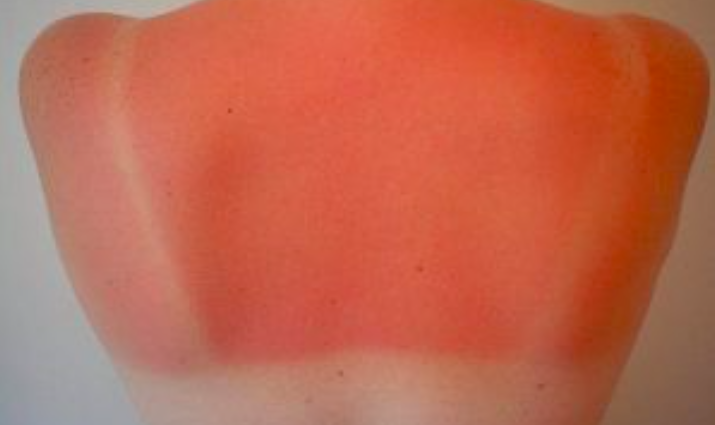 Chống Cháy Nắng: Cách Ngăn Ngừa Và 7 Mẹo Chăm Sóc Da Tự Nhiên Sau Khi Bị Cháy Nắng Chống Cháy Nắng: Cách Ngăn Ngừa Và 7 Mẹo Chăm Sóc Da Tự Nhiên Sau Khi Bị Cháy Nắng