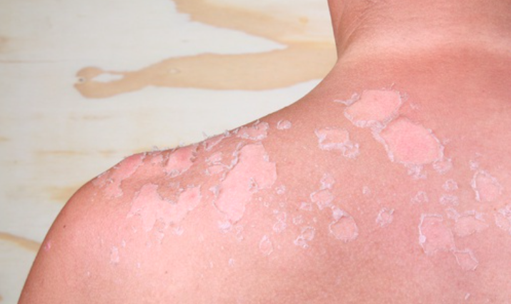 Chống Cháy Nắng: Cách Ngăn Ngừa Và 7 Mẹo Chăm Sóc Da Tự Nhiên Sau Khi Bị Cháy Nắng Chống Cháy Nắng: Cách Ngăn Ngừa Và 7 Mẹo Chăm Sóc Da Tự Nhiên Sau Khi Bị Cháy Nắng