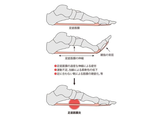 Tự Kiểm Tra, Phòng Ngừa Và Giãn Cơ Viêm Cân Gan Chân! Tự Kiểm Tra, Phòng Ngừa Và Giãn Cơ Viêm Cân Gan Chân!