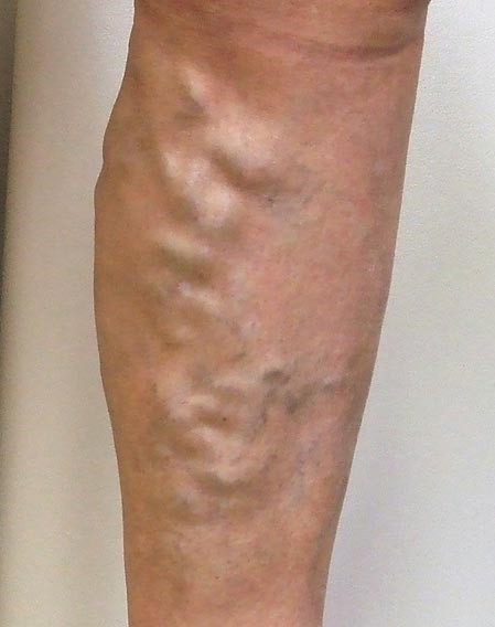 Khoảng 60% Người Trên 50 Tuổi! Ai Dễ Bị Giãn Tĩnh Mạch? Khoảng 60% Người Trên 50 Tuổi! Ai Dễ Bị Giãn Tĩnh Mạch?