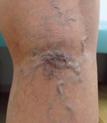 Khoảng 60% Người Trên 50 Tuổi! Ai Dễ Bị Giãn Tĩnh Mạch? Khoảng 60% Người Trên 50 Tuổi! Ai Dễ Bị Giãn Tĩnh Mạch?