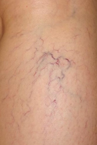 Khoảng 60% Người Trên 50 Tuổi! Ai Dễ Bị Giãn Tĩnh Mạch? Khoảng 60% Người Trên 50 Tuổi! Ai Dễ Bị Giãn Tĩnh Mạch?