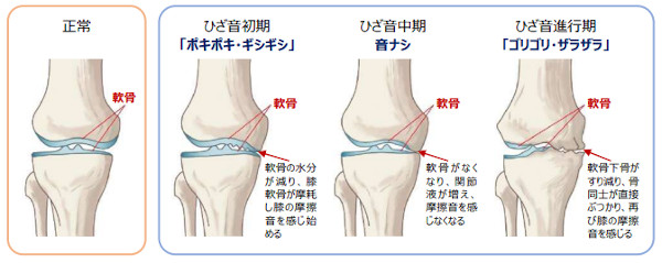 Hãy Chú Ý Ngay Cả Khi Bạn Không Cảm Thấy Đau! Đừng Bỏ Qua "Tiếng Kêu Ở Đầu Gối" Hãy Chú Ý Ngay Cả Khi Bạn Không Cảm Thấy Đau! Đừng Bỏ Qua "Tiếng Kêu Ở Đầu Gối"