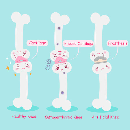 Hãy Chú Ý Ngay Cả Khi Bạn Không Cảm Thấy Đau! Đừng Bỏ Qua "Tiếng Kêu Ở Đầu Gối" Hãy Chú Ý Ngay Cả Khi Bạn Không Cảm Thấy Đau! Đừng Bỏ Qua "Tiếng Kêu Ở Đầu Gối"