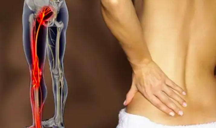 Làm thế nào để biết bạn có bị đau thần kinh tọa hay không Làm thế nào để biết bạn có bị đau thần kinh tọa hay không