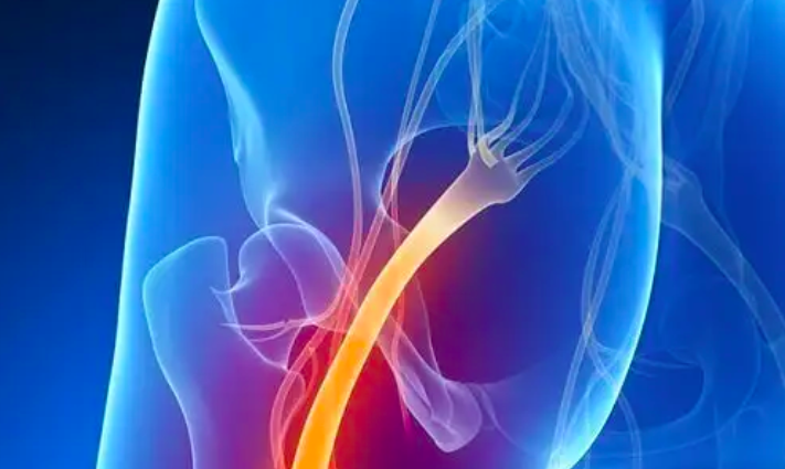 Làm thế nào để biết bạn có bị đau thần kinh tọa hay không Làm thế nào để biết bạn có bị đau thần kinh tọa hay không