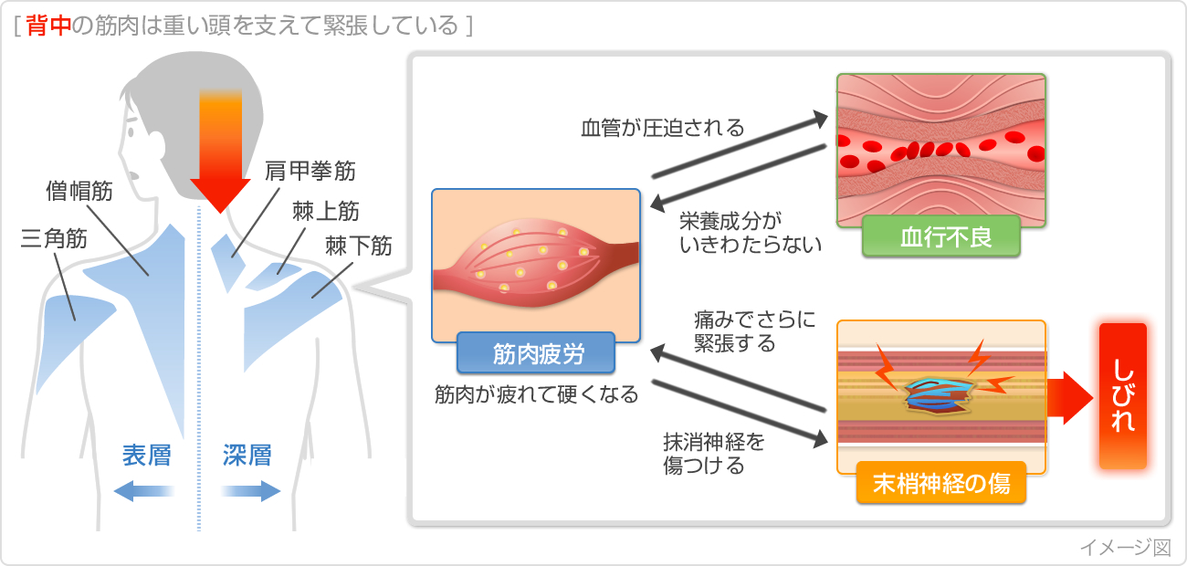 Nguyên Nhân Gây Cứng Vai Nguyên Nhân Gây Cứng Vai