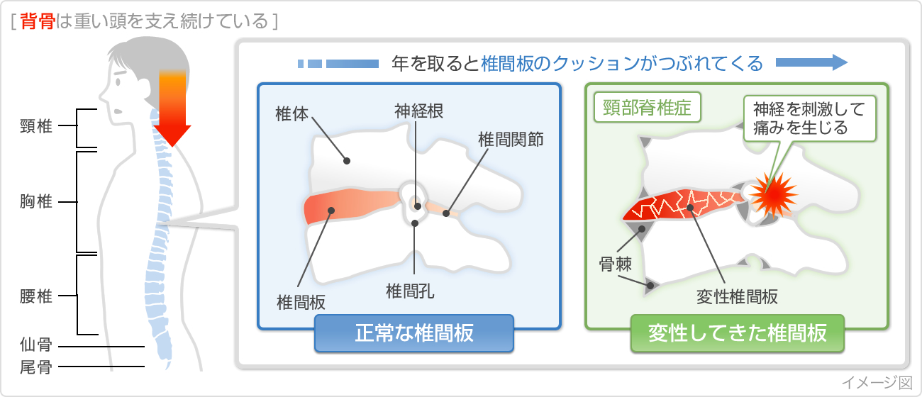 Nguyên Nhân Gây Cứng Vai Nguyên Nhân Gây Cứng Vai