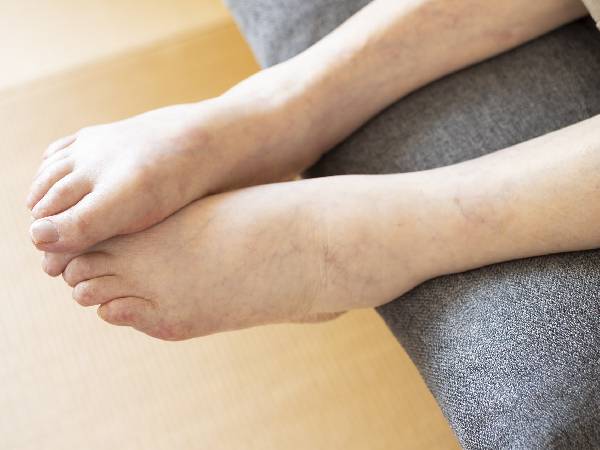 Nguyên Nhân Gây Sưng Chân Là Gì? Một Dấu Hiệu Của Bệnh Tật? Biện Pháp Khắc Phục Và Cách Phòng Ngừa Nguyên Nhân Gây Sưng Chân Là Gì? Một Dấu Hiệu Của Bệnh Tật? Biện Pháp Khắc Phục Và Cách Phòng Ngừa