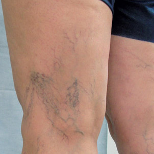 Những Dấu Hiệu Của Bệnh Giãn Tĩnh Mạch Là Gì? Tự Kiểm Tra Và Chẩn Đoán Qua Hình Ảnh. Những Dấu Hiệu Của Bệnh Giãn Tĩnh Mạch Là Gì? Tự Kiểm Tra Và Chẩn Đoán Qua Hình Ảnh.