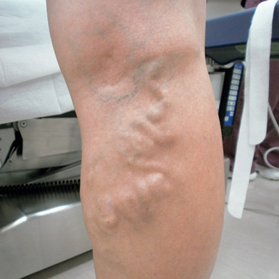 Những Dấu Hiệu Của Bệnh Giãn Tĩnh Mạch Là Gì? Tự Kiểm Tra Và Chẩn Đoán Qua Hình Ảnh. Những Dấu Hiệu Của Bệnh Giãn Tĩnh Mạch Là Gì? Tự Kiểm Tra Và Chẩn Đoán Qua Hình Ảnh.