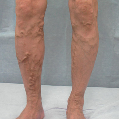 Những Dấu Hiệu Của Bệnh Giãn Tĩnh Mạch Là Gì? Tự Kiểm Tra Và Chẩn Đoán Qua Hình Ảnh. Những Dấu Hiệu Của Bệnh Giãn Tĩnh Mạch Là Gì? Tự Kiểm Tra Và Chẩn Đoán Qua Hình Ảnh.