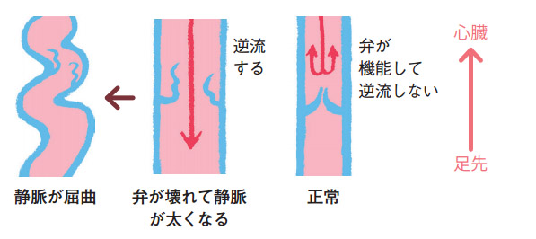 Những Dấu Hiệu Của Bệnh Giãn Tĩnh Mạch Là Gì? Tự Kiểm Tra Và Chẩn Đoán Qua Hình Ảnh. Những Dấu Hiệu Của Bệnh Giãn Tĩnh Mạch Là Gì? Tự Kiểm Tra Và Chẩn Đoán Qua Hình Ảnh.