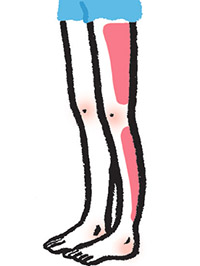 Những Dấu Hiệu Của Bệnh Giãn Tĩnh Mạch Là Gì? Tự Kiểm Tra Và Chẩn Đoán Qua Hình Ảnh. Những Dấu Hiệu Của Bệnh Giãn Tĩnh Mạch Là Gì? Tự Kiểm Tra Và Chẩn Đoán Qua Hình Ảnh.