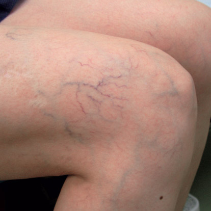 Những Dấu Hiệu Của Bệnh Giãn Tĩnh Mạch Là Gì? Tự Kiểm Tra Và Chẩn Đoán Qua Hình Ảnh. Những Dấu Hiệu Của Bệnh Giãn Tĩnh Mạch Là Gì? Tự Kiểm Tra Và Chẩn Đoán Qua Hình Ảnh.