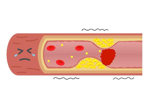 Cải Thiện Và Phòng Ngừa Xơ Cứng Động Mạch Qua Việc Kéo Dãn! Hướng Dẫn Và Lợi Ích Cải Thiện Và Phòng Ngừa Xơ Cứng Động Mạch Qua Việc Kéo Dãn! Hướng Dẫn Và Lợi Ích