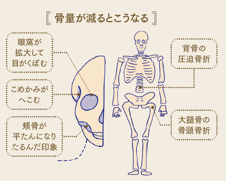 Bác Sĩ Khuyến Nghị Lối Sống, Dinh Dưỡng Và Tập Luyện Cho Sức Khỏe Xương Tuổi 50 Bác Sĩ Khuyến Nghị Lối Sống, Dinh Dưỡng Và Tập Luyện Cho Sức Khỏe Xương Tuổi 50