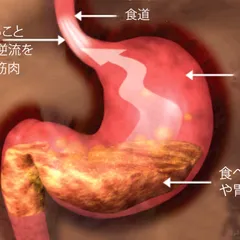 CHẾ ĐỘ DINH DƯỠNG CHO NGƯỜI BỊ TRÀO NGƯỢC DẠ DÀY THỰC QUẢN