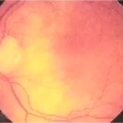 BIẾN CHỨNG LIÊN QUAN ĐẾN BỆNH TIỂU ĐƯỜNG