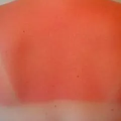 CHỐNG CHÁY NẮNG: CÁCH NGĂN NGỪA VÀ 7 MẸO CHĂM SÓC DA TỰ NHIÊN SAU KHI BỊ CHÁY NẮNG