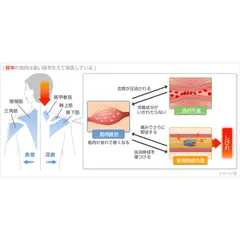 NGUYÊN NHÂN GÂY CỨNG VAI