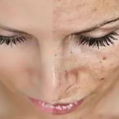 5 NGUYÊN NHÂN GÂY LÃO HÓA SỚM