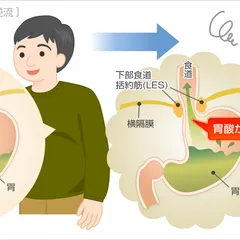 NGUYÊN NHÂN GÂY Ợ NÓNG