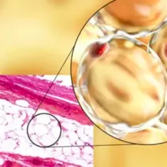 TẦM QUAN TRỌNG CỦA ADIPONECTIN