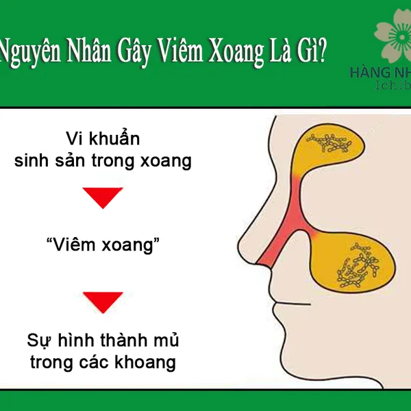 THUỐC XỊT VIÊM MŨI CHIKUNAIN - GIẢI PHÁP HIỆU QUẢ CHO NGHẸT MŨI