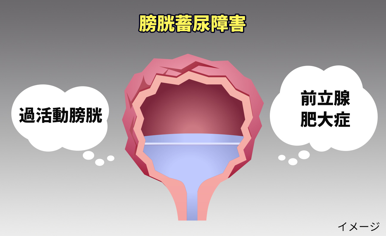 Tiểu Đêm Là Gì? Nguyên Nhân Và Cách Xử Lý Hiệu Quả Tiểu Đêm Là Gì? Nguyên Nhân Và Cách Xử Lý Hiệu Quả