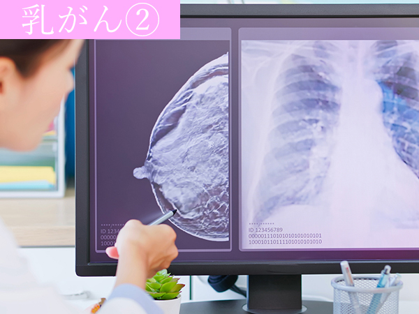 Ung Thư Vú - Căn Bệnh Phụ Nữ Trên 50 Cần Chú Ý Ung Thư Vú - Căn Bệnh Phụ Nữ Trên 50 Cần Chú Ý