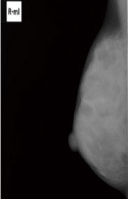 Ung Thư Vú - Căn Bệnh Phụ Nữ Trên 50 Cần Chú Ý Ung Thư Vú - Căn Bệnh Phụ Nữ Trên 50 Cần Chú Ý