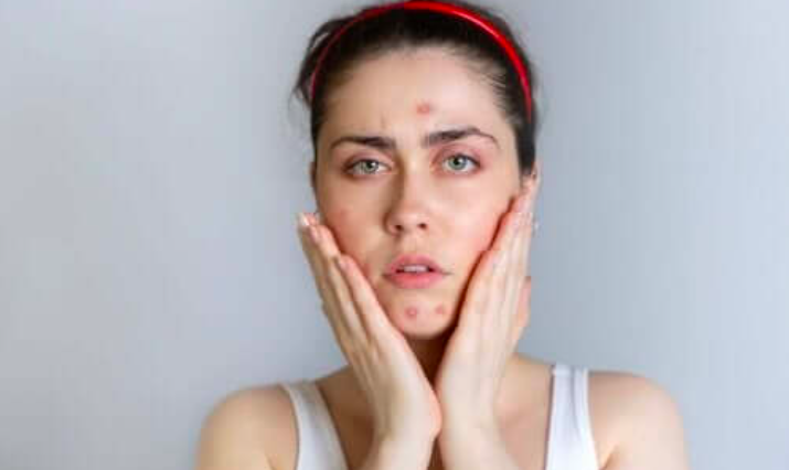 Vì Sao Phụ Nữ Dễ Nổi Mụn Trong Kỳ Kinh Nguyệt? Vì Sao Phụ Nữ Dễ Nổi Mụn Trong Kỳ Kinh Nguyệt?