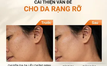 TOP NHỮNG SẢN PHẨM NHẤT ĐỊNH PHẢI CÓ SAU KHI TÁI TẠO DA
