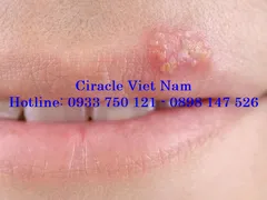 Những loại mụn tuyệt đối hạn chế nặn Những loại mụn tuyệt đối hạn chế nặn