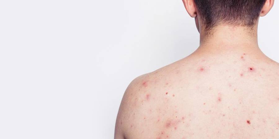 mụn lưng ngực mụn lưng ngực