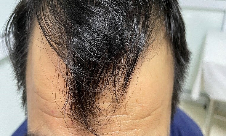 chữa hói đầu chữa hói đầu