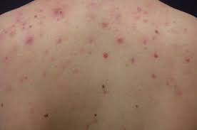 xà bông trị mụn xà bông trị mụn