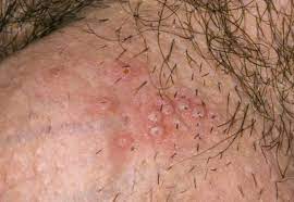 viêm nang lông dương vật viêm nang lông dương vật