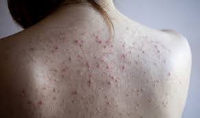 xà bông cục trị mụn lưng xà bông cục trị mụn lưng