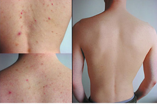 xà phòng tắm trị mụn xà phòng tắm trị mụn