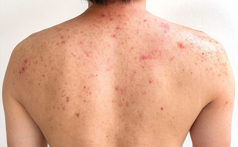 xà phòng tắm trị mụn lưng xà phòng tắm trị mụn lưng