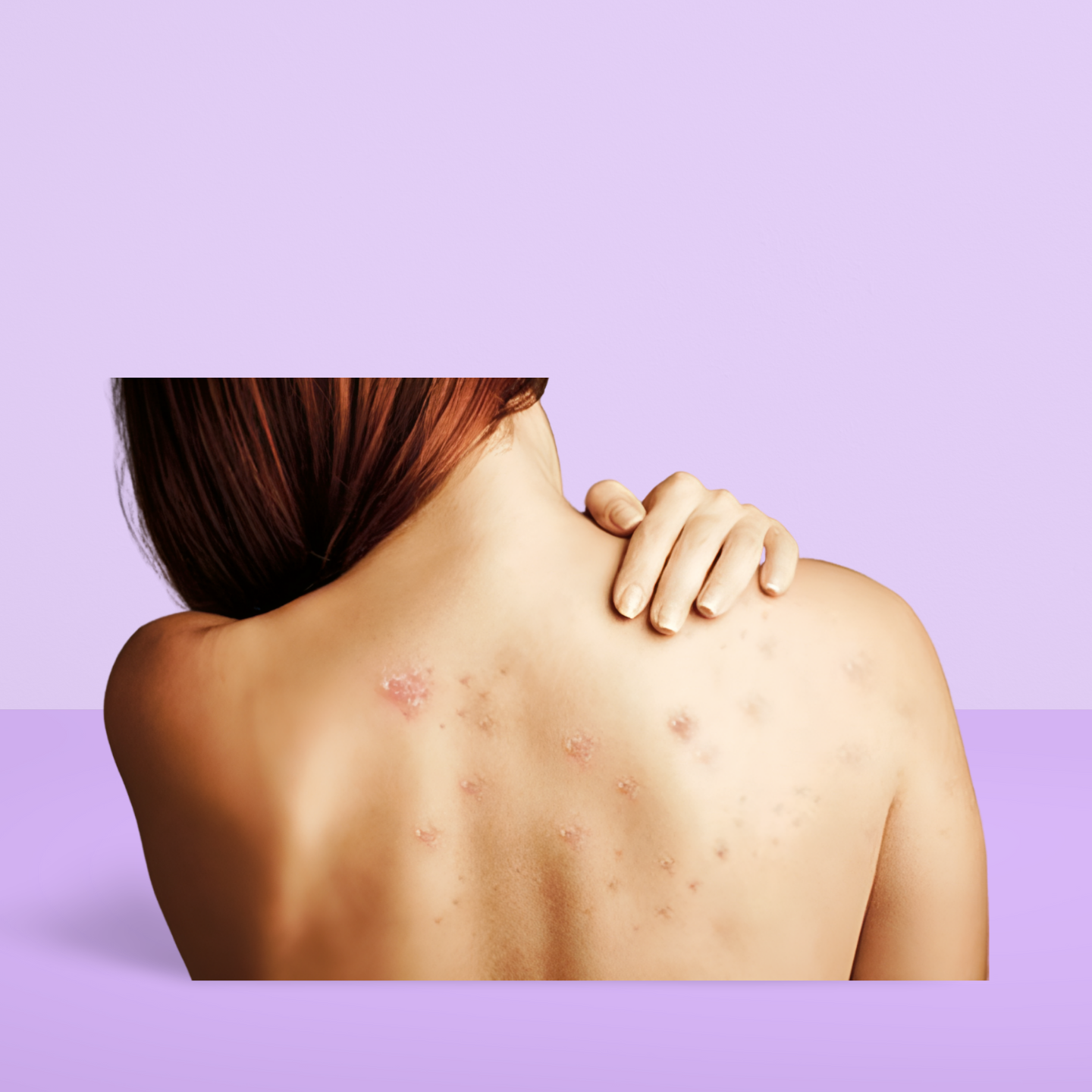 xà phòng trị mụn lưng for back xà phòng trị mụn lưng for back