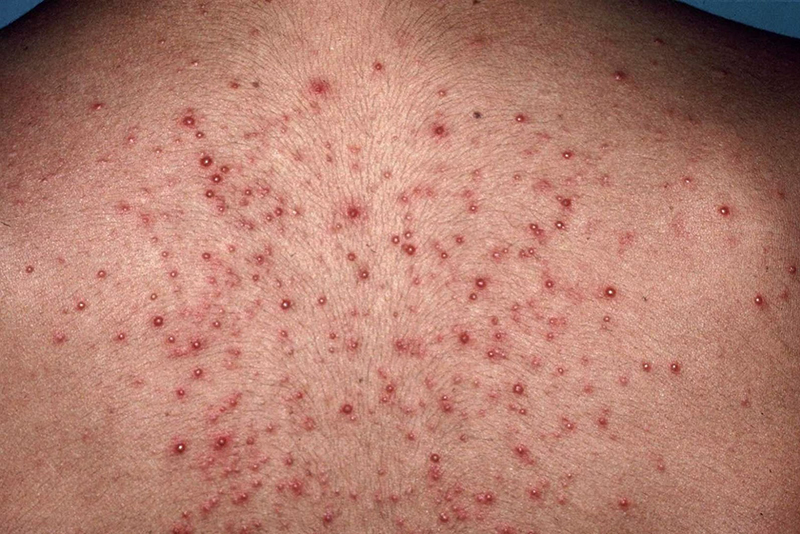 bệnh viêm nang lông bệnh viêm nang lông