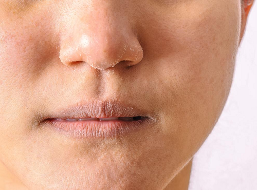 chàm môi chàm môi